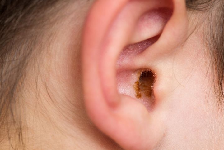 Bouchon de cérumen : image de l'oreille d'une enfant avec du cérumen.