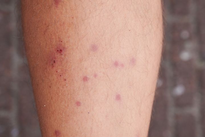 Comment reconnaître et traiter une piqûre d'aoûtat ? Des piqûres d'acarien sur une jambe. Boutons rouges en grappe.